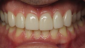 Smile Gallery - After