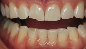 Smile Gallery - Before